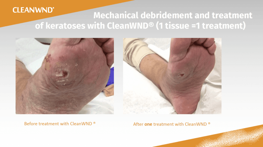 CleanWND® debridement documentation, before and after. Manufacturer slide 1 of 3.