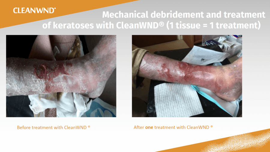 CleanWND® clinical evidence series. Manufacturer slide 2 of 3.
