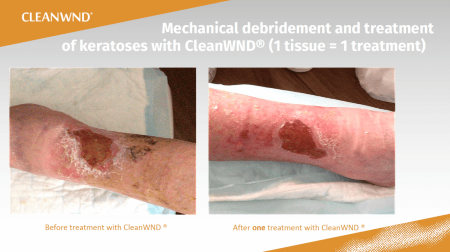 CleanWND® clinical evidence series. Manufacturer slide 3 of 3.